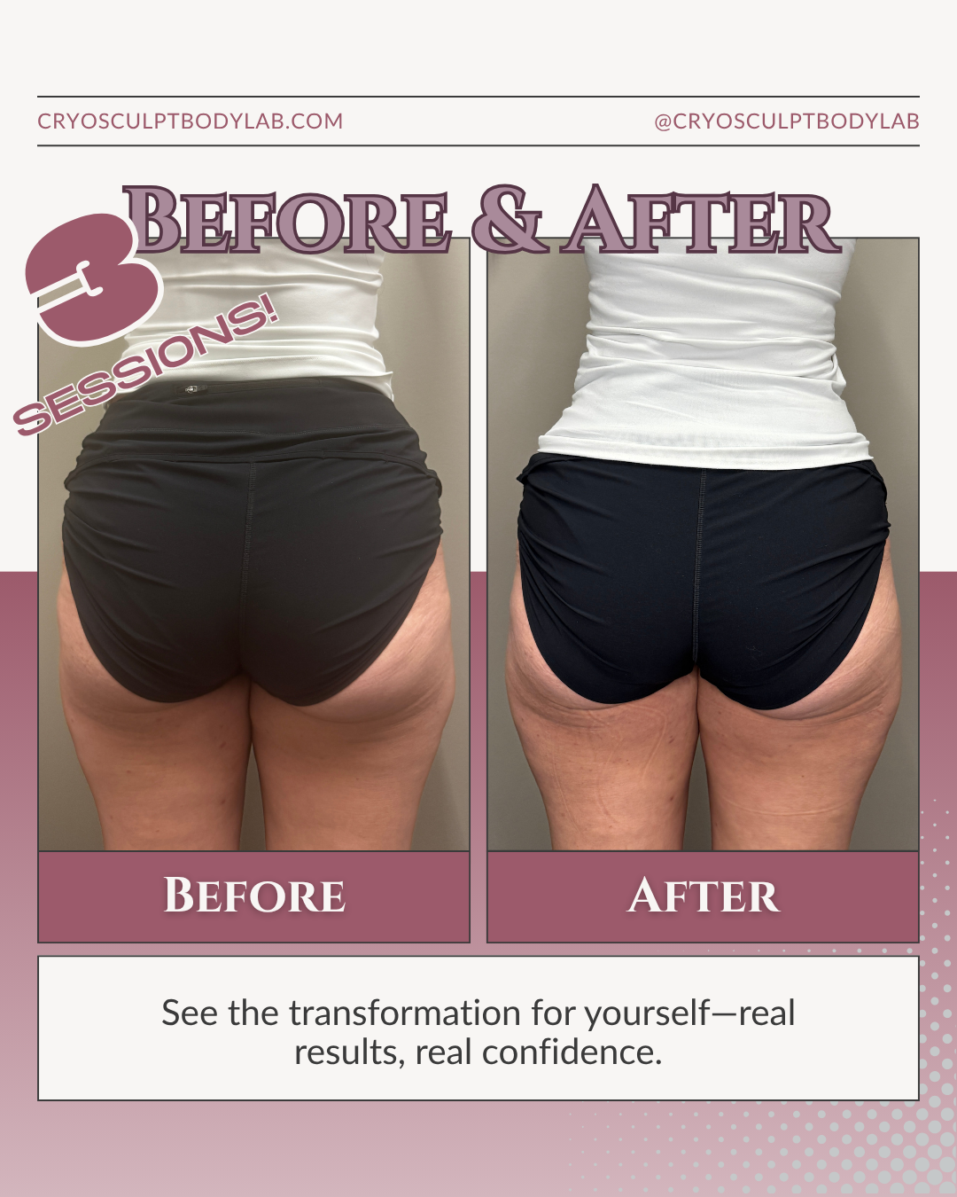 Before and after CryoSculpt results
