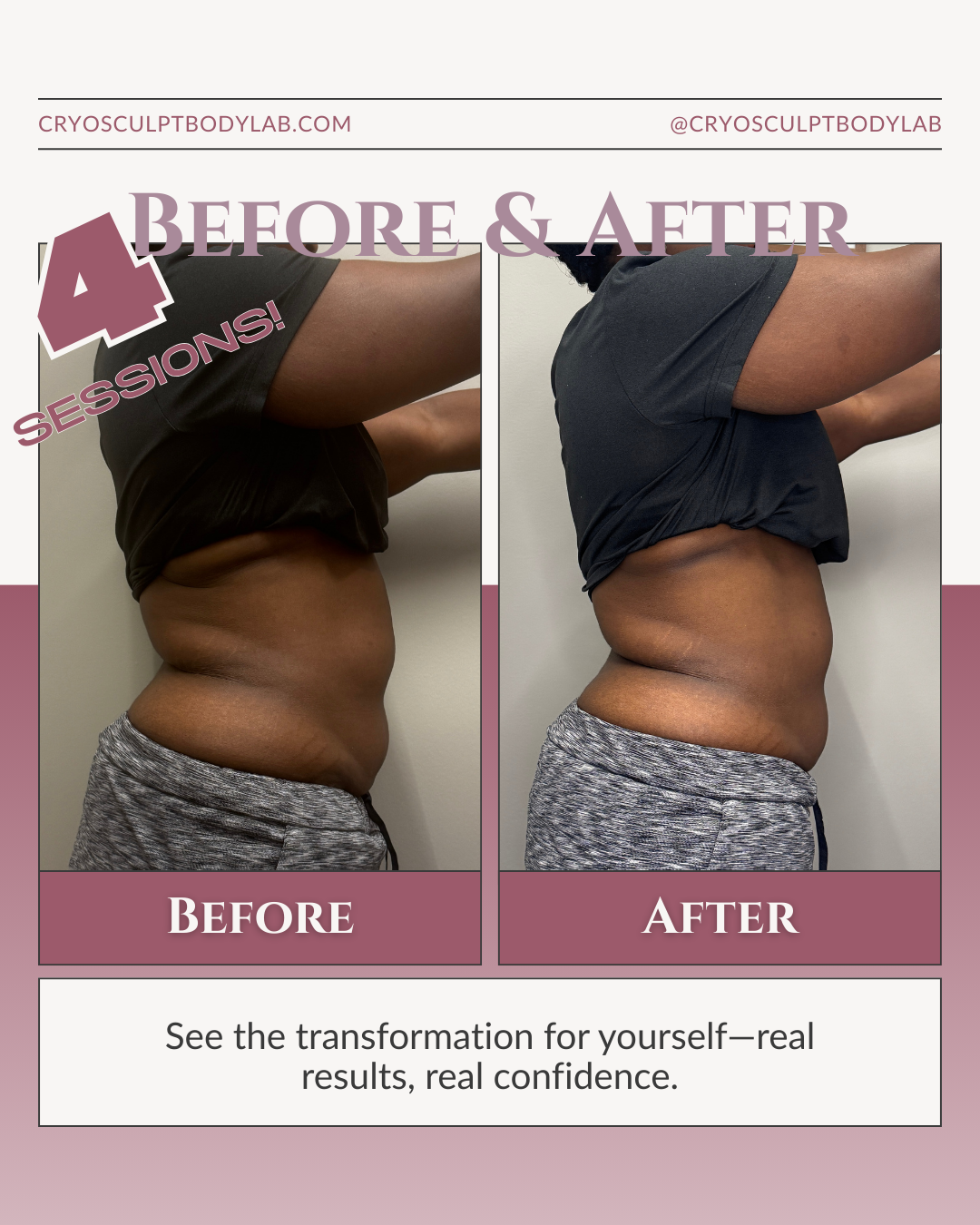 Before and after CryoSculpt results