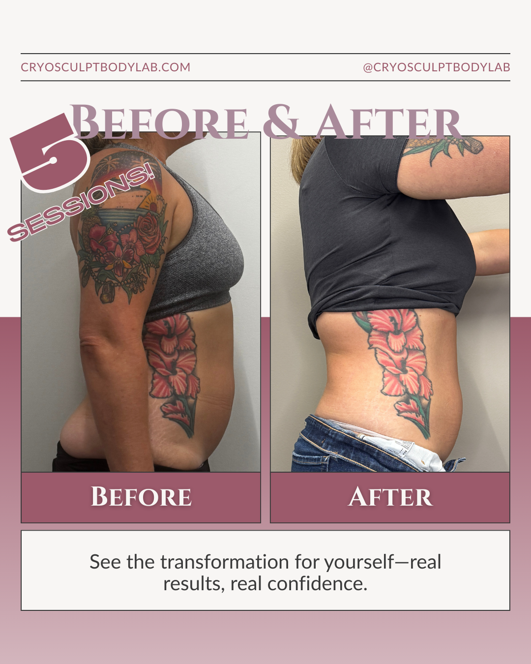 Before and after CryoSculpt results