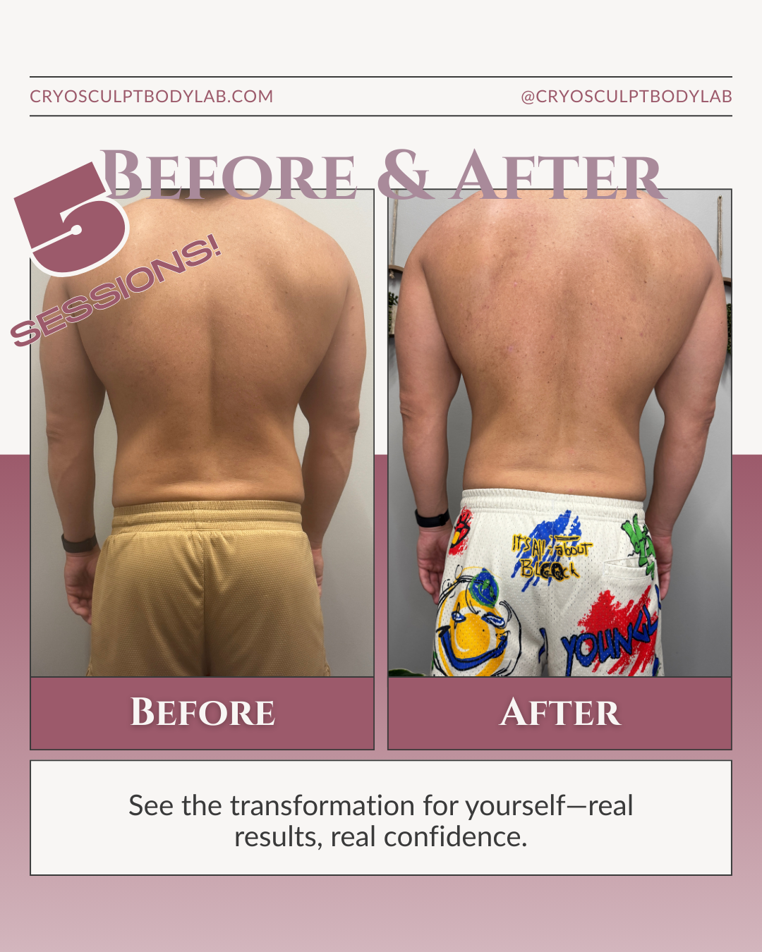 Before and after CryoSculpt results