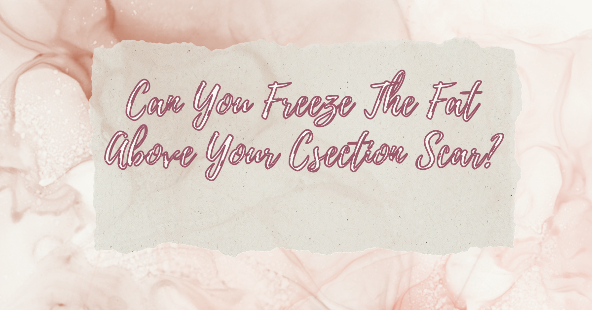 Targeting That C-Section Pouch with Cryolipolysis