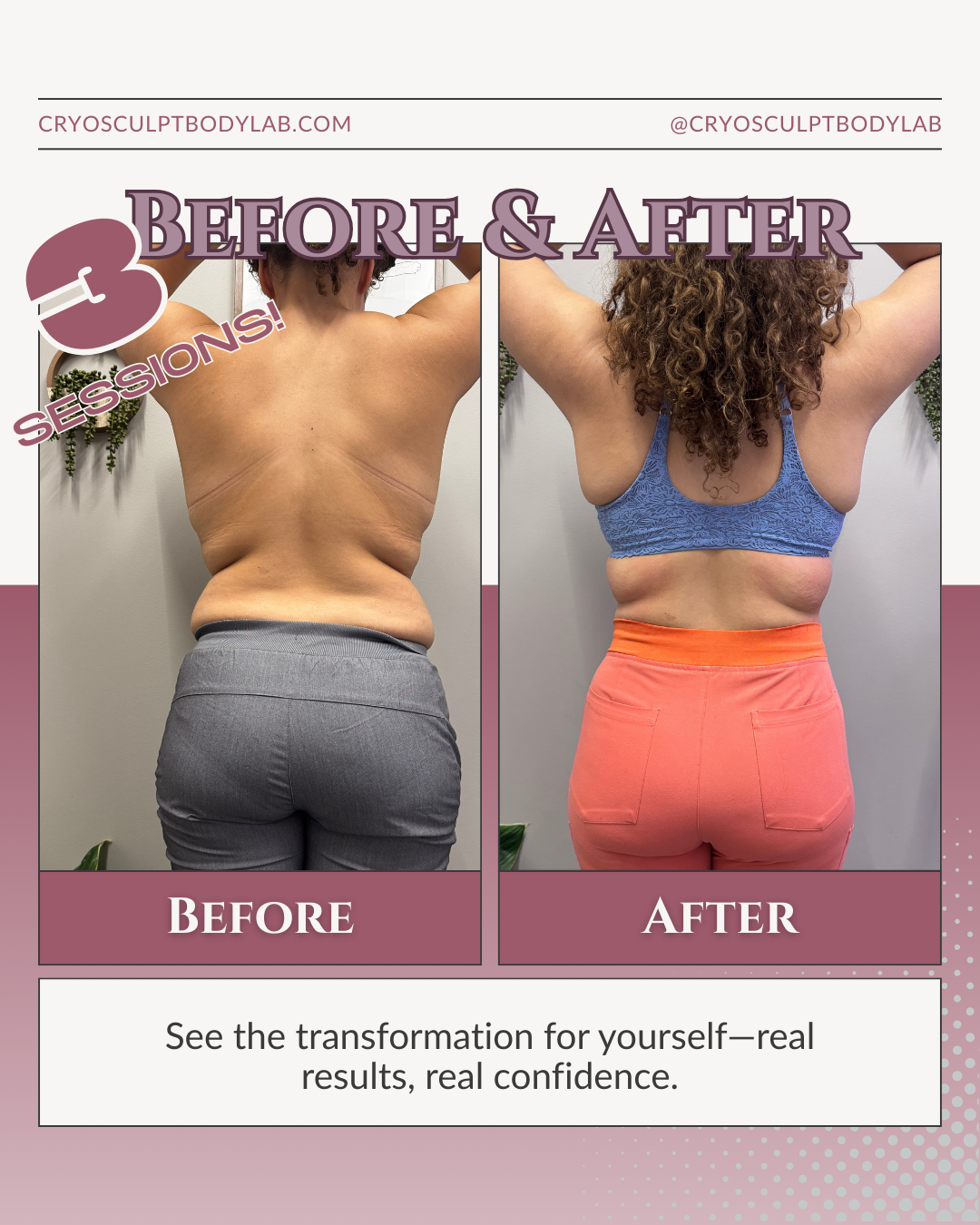Before and after CryoSculpt results