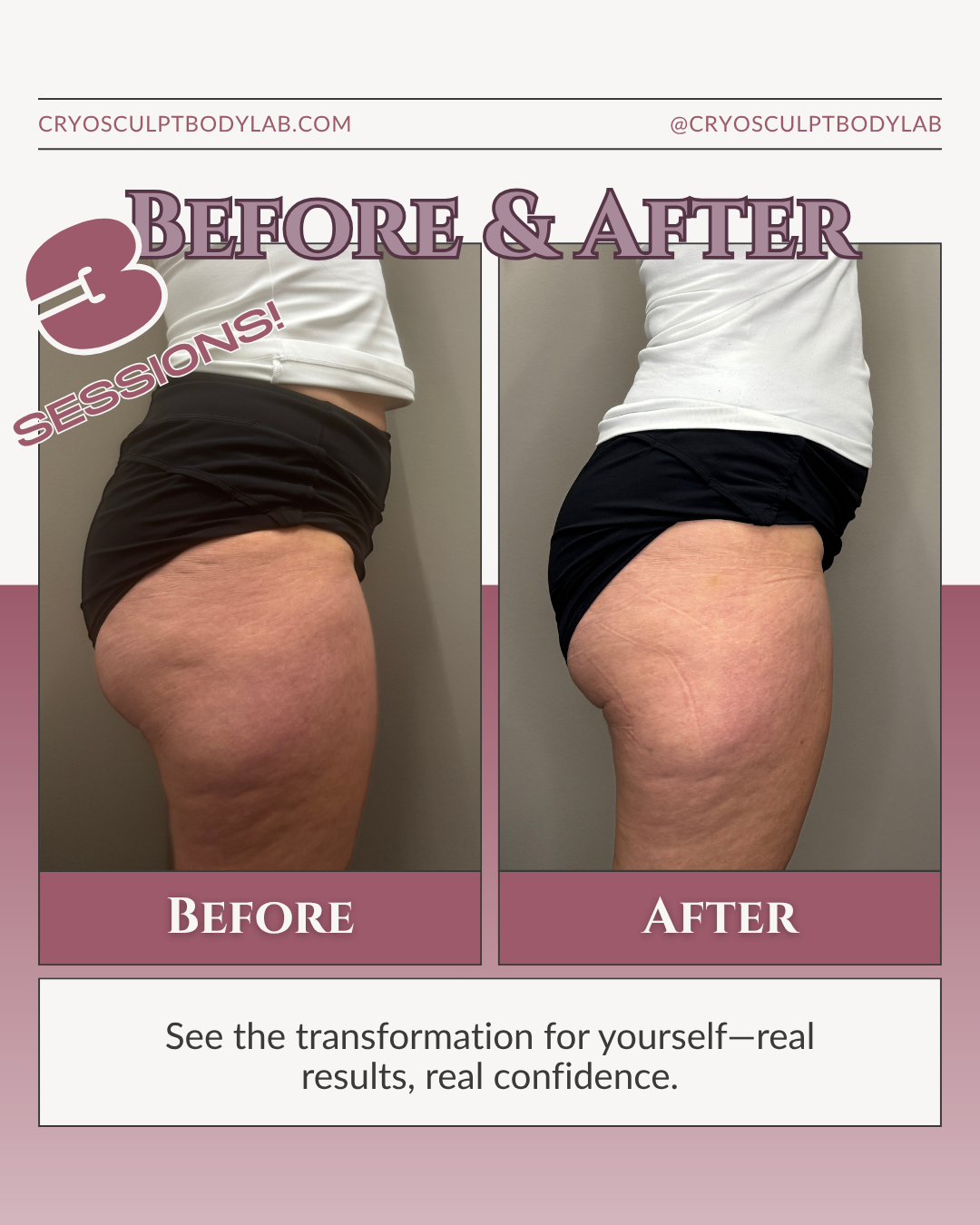 Before and after CryoSculpt results