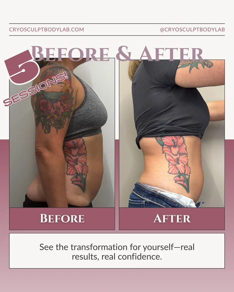Before and after CryoSculpt results
